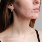 acne em adultos