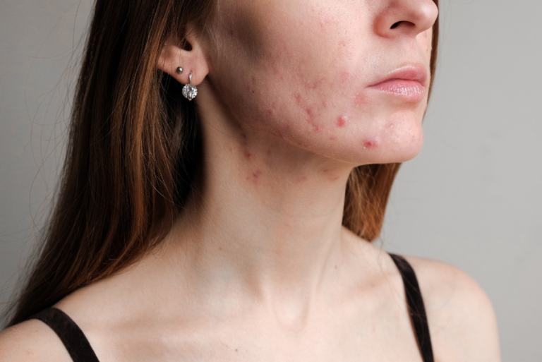 acne em adultos