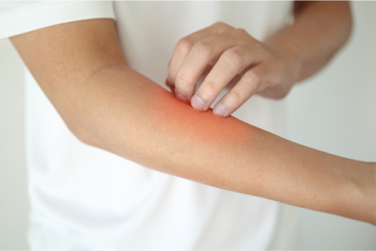 Dermatite: tipos, sintomas e formas de controle2