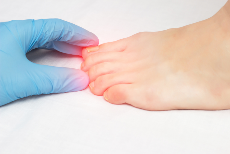 Cirurgia de unha encravada: quando o procedimento é indicado e como funciona